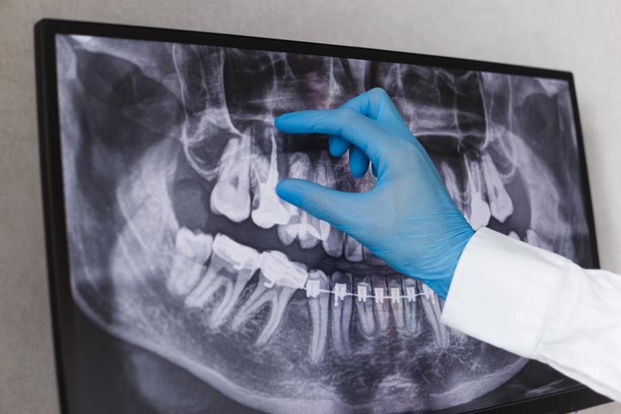 Bone Grafting in Implant Dentistry: Supporting Long-Term Success Through Structural Stability